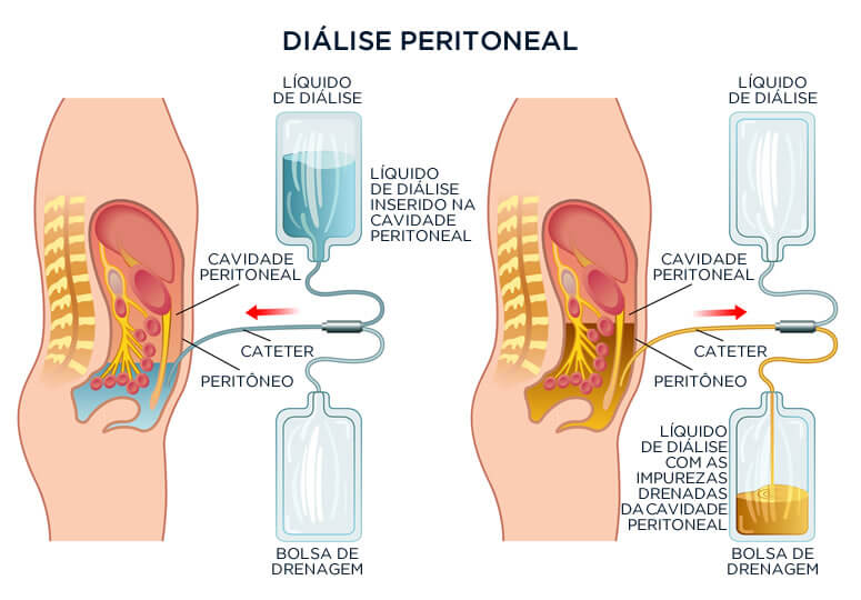 Diálise Peritoneal