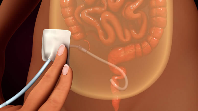 Colocação de cateter de Diálise Peritoneal