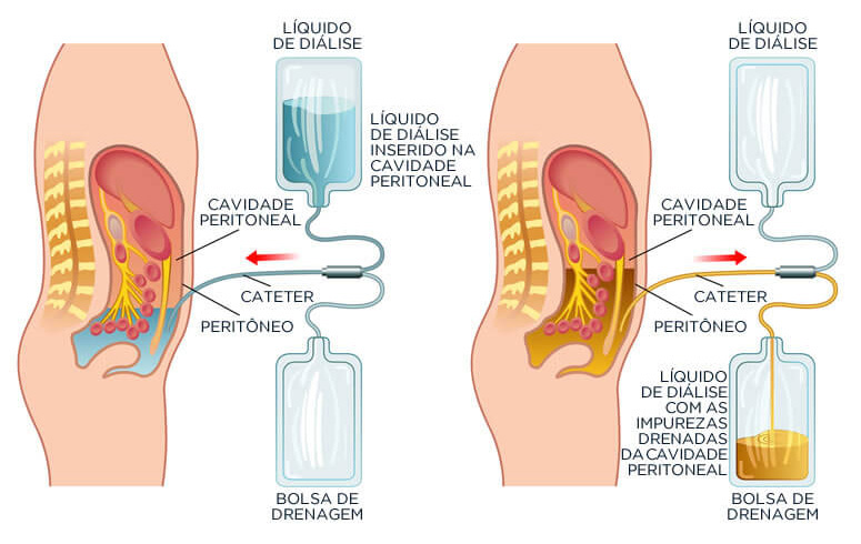 Preparo da Diálise Peritoneal