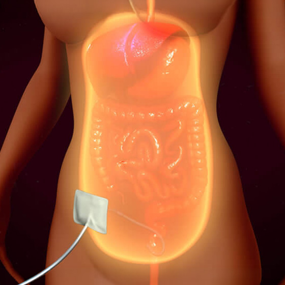 Diálise Peritoneal