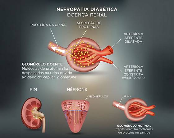 Como Ocorre a Nefropatia Diabética